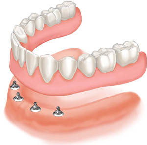 dentures-implants